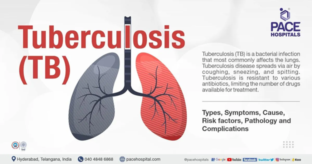 Tuberculosis - Tubercle Bacillus